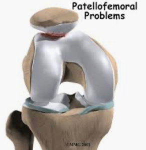 patella pain,kneecap pain,patellofemoral pain syndrome
