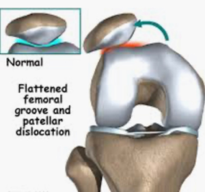 patella pain,kneecap pain,patellofemoral pain syndrome