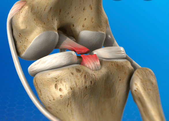 Pcl Posterior Cruciate Ligament Injuries - ISMI